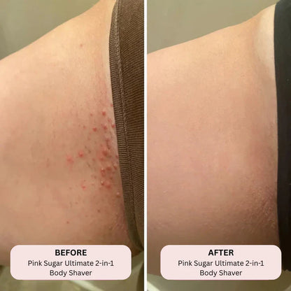 TONDEUSE À BIKINI DÉFINITIVE - VAOCOM™